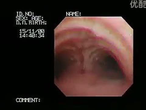 我在爱奇艺看了纤维支气管镜检查_标清. 来自